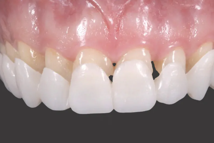 Виниры для зубов верх Snap On Smile