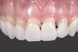 Виниры для зубов верх Snap On Smile